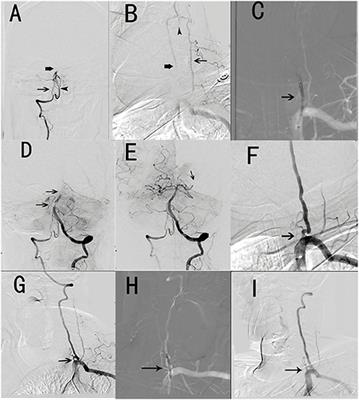 A Case Series and Literature Review of Vertebral Artery Stump Syndrome